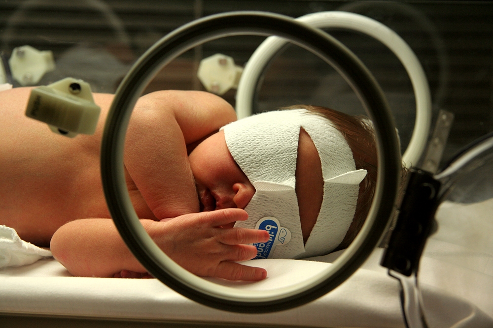 Samantha undergoing phototherapy to treat her jaundice